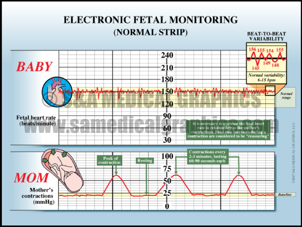 Electronic Fetal Monitoring Normal