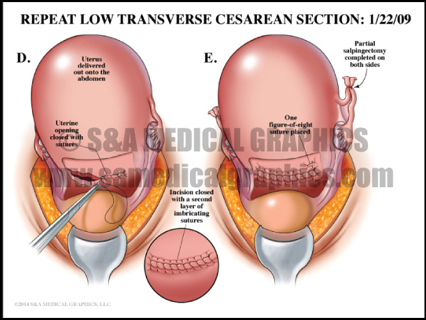 Cesarean Section Medical Illustration