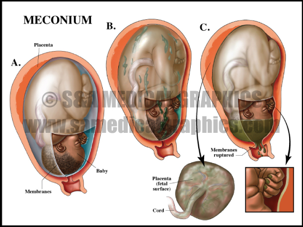 Meconium Medical Illustration