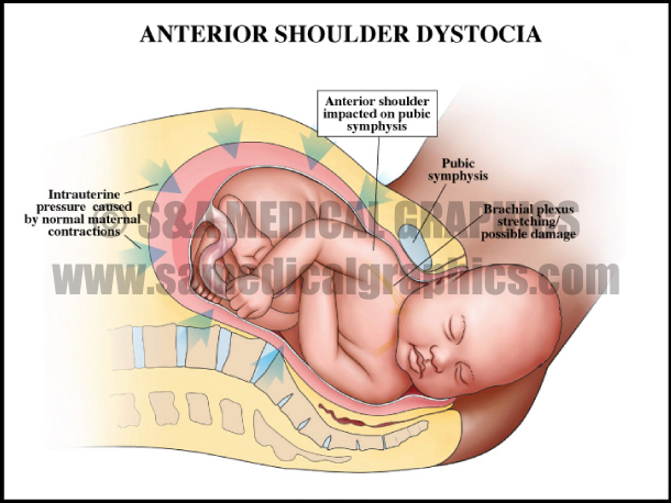 Anterior Shoulder Dystocia