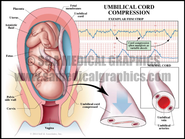 Umbilical Cord Compression