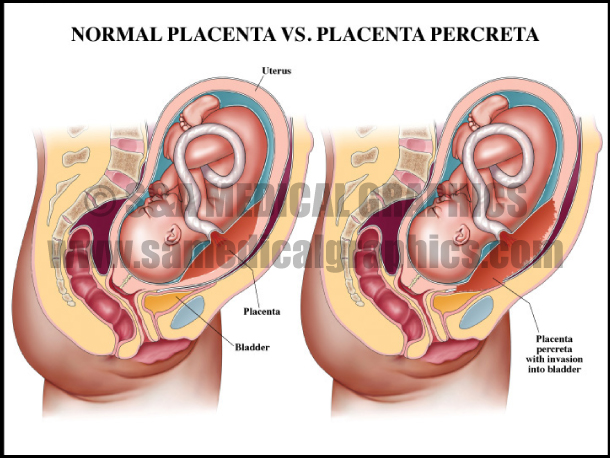 Normal Placenta vs. Placenta Percreta