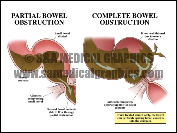 abdominopelvic surgery bowel obstruction