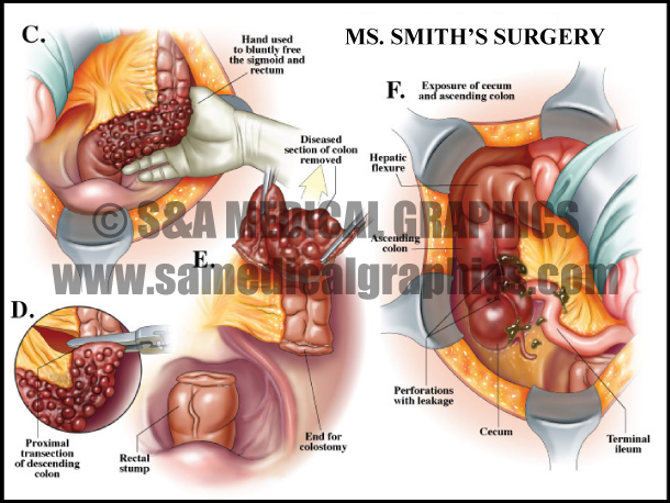 Bowel Perforation surgery abdominopelvic