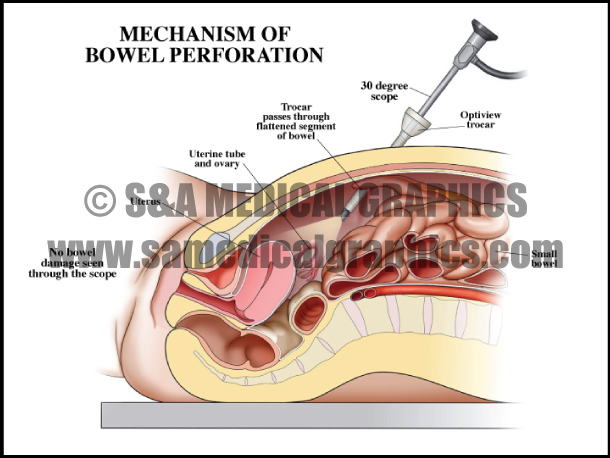 Abdominopelvic Surgery Bowel Perforation