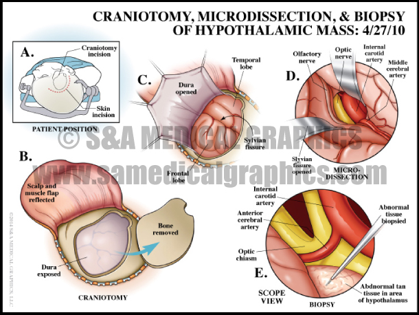 Craniotomy, Microdissection, & Biopsy of Hypothalamic Mass