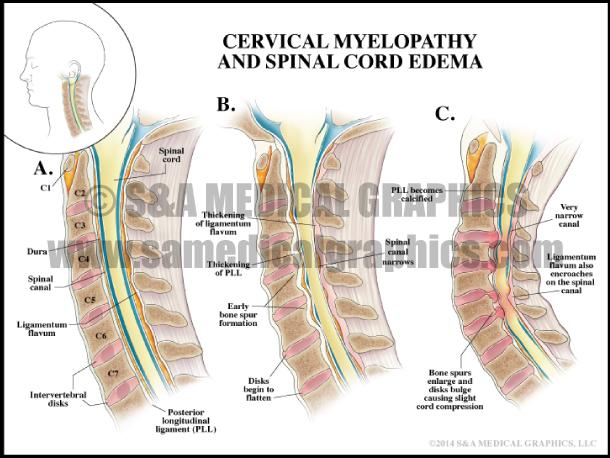 Cervical Myelopathy and Spinal Cord Edema