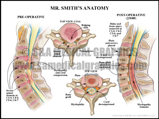 Myelopathy and Spinal Cord Compression