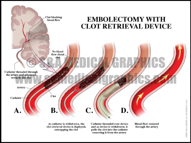 Embolectomy With Clot Retrieval Device