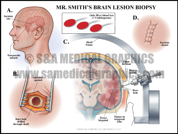 Brain Lesion Biopsy