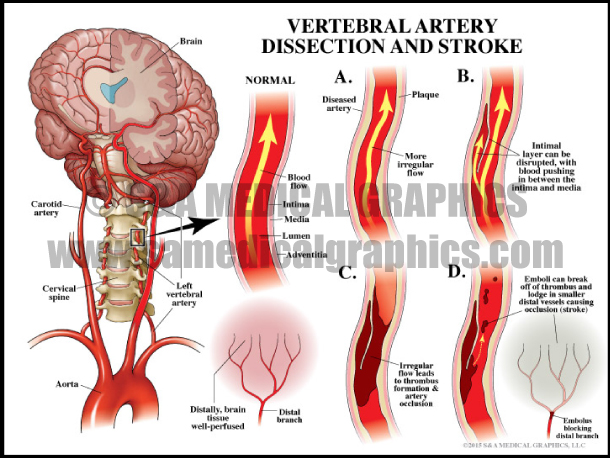 Vertebral Artery Dissection and Stroke
