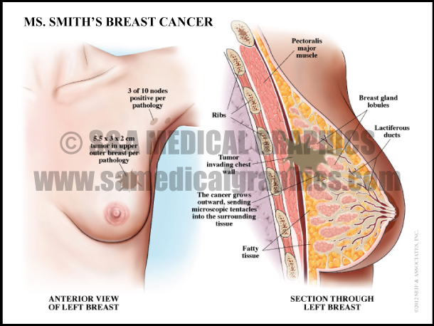 Breast Cancer Medical Illustration