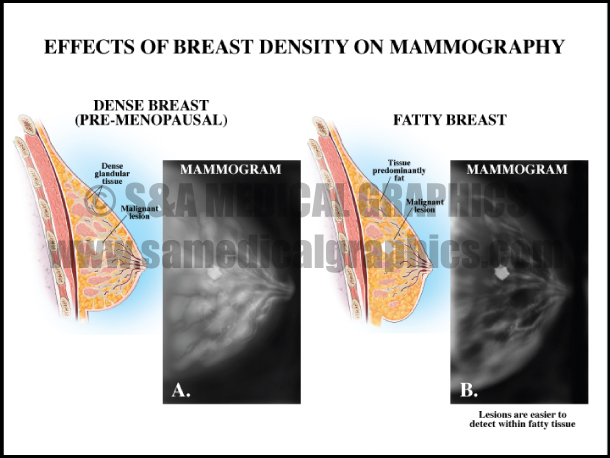 Effects of Breast Density of Mammography