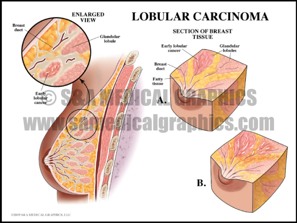 Lobular Carcinoma
