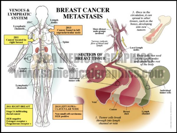 Preast Cancer Breast Cancer - S&A Medical Graphics