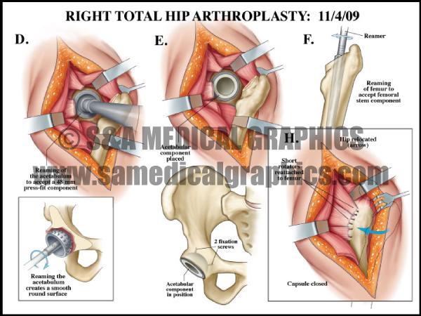 Total Hip Arthroplasty Medical Illustration