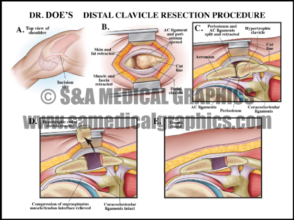 Distal Clavicle Resection Procedure Medical Illustration