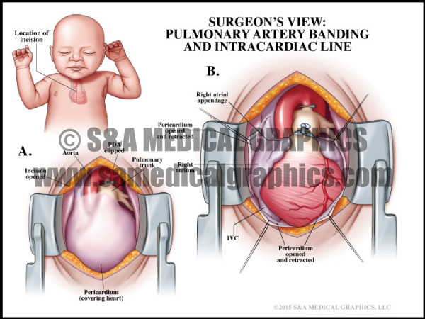Heart Surgery Medical Illustration