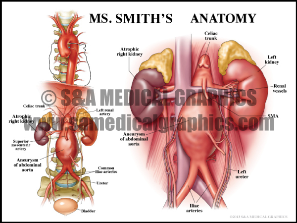 Aneurysm Medical Illustration