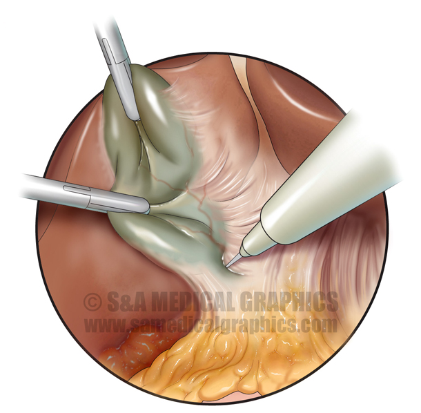 Cholecystectomy Bile Duct Injury Medical Illustration