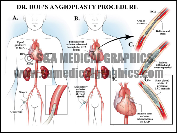 Angioplasty Procedure Sample