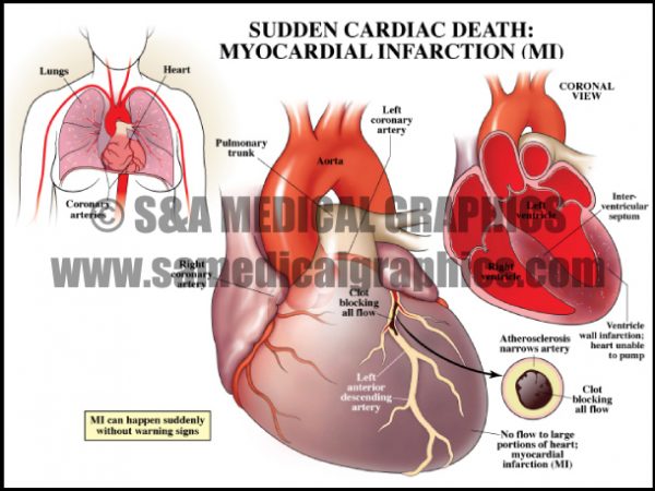 Coronary Artery Disease - S&A Medical Graphics