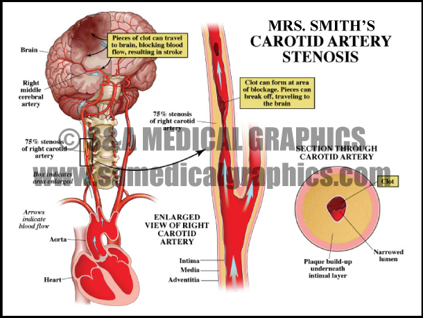 Carotid Artery Stenosis Sample