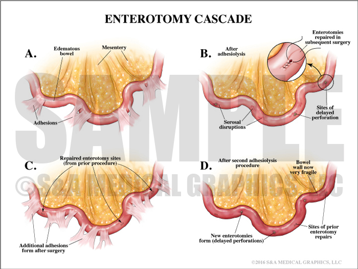 Enterotomy Cascade Medical Illustration