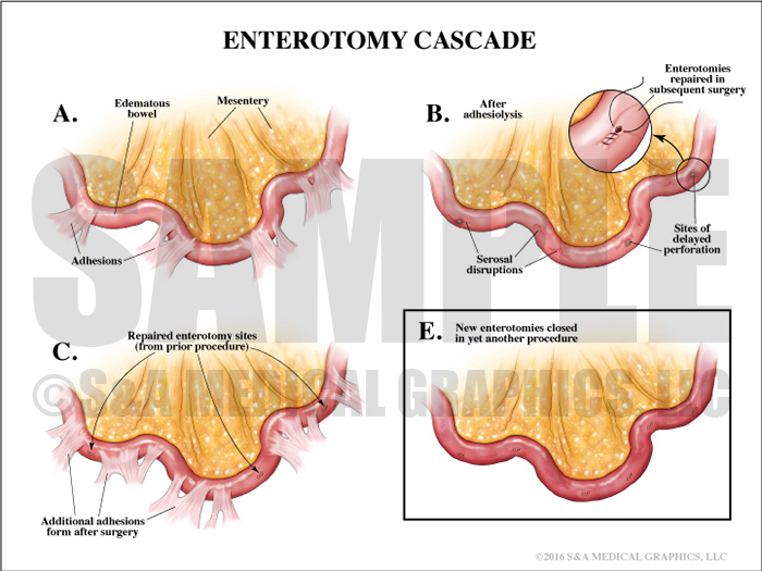 Enterotomy Cascade Medical Illustration