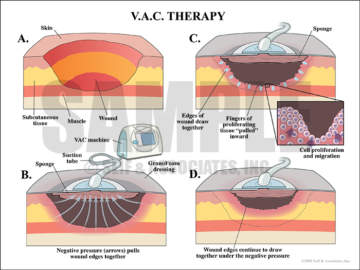 V.A.C. Therapy Medical Illustration