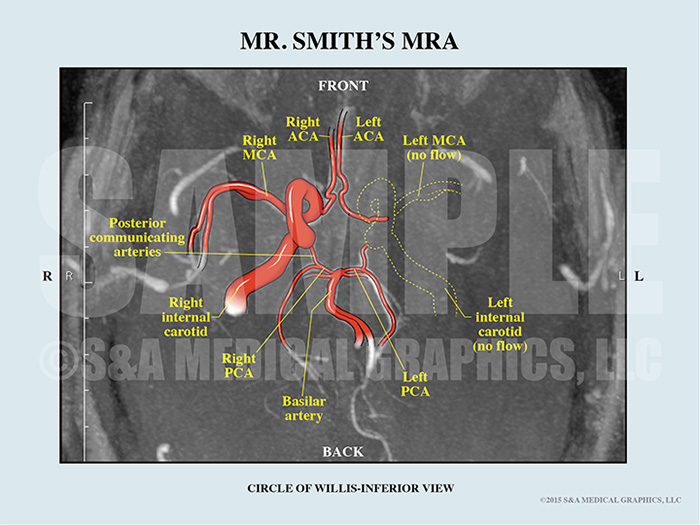 MRA Scan With Medical Illustration Interpretation
