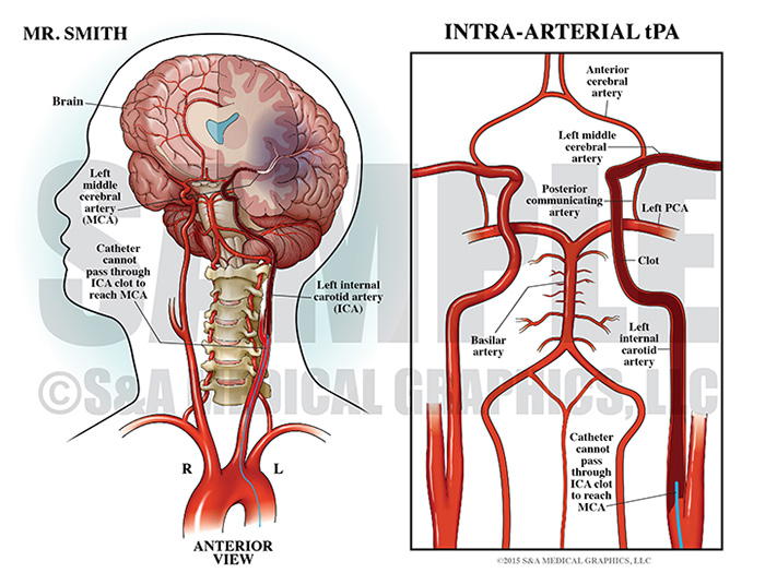 Intra-Arterial tPA Clot