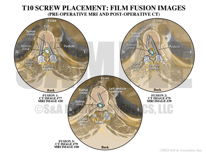 T10 Screw Placement Spine Fusion CT