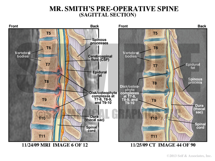 preoperative spine ct medical illustration