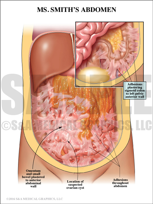Patient's Abdominal Anatomy Adhesions Medical Illustration
