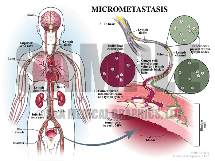 Micrometastasis Medical Illustration