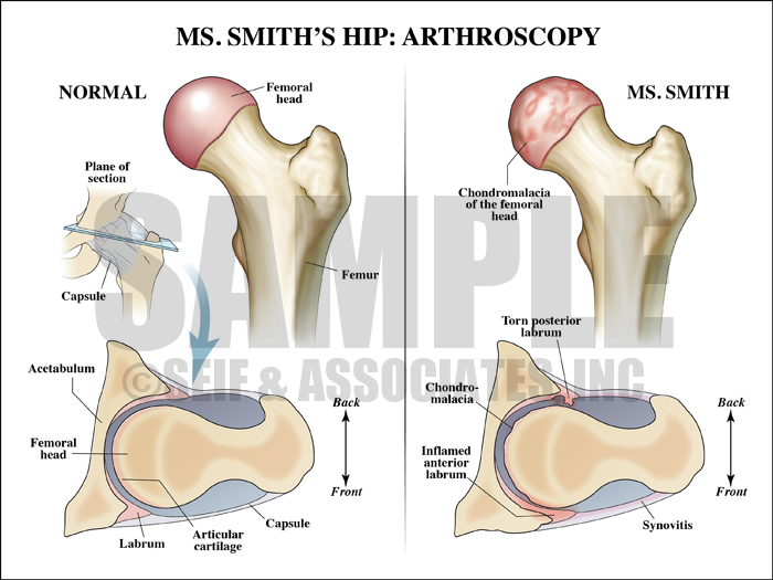 Hip Arthroscopy Procedure Medical Illustration