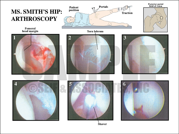 Hip Arthroscopy Procedure