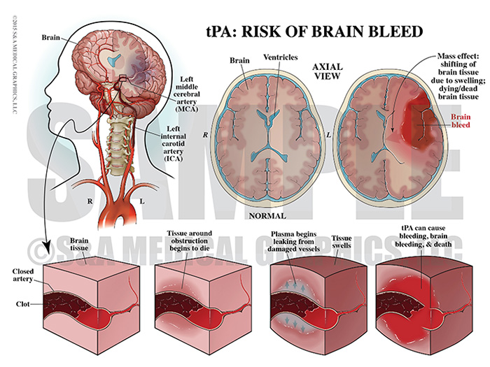 tPA Risk of Brain Bleed