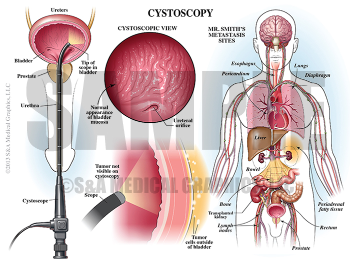 Cystoscopy Procedure Medical Illustration