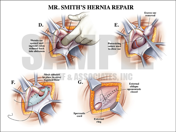 Hernia Repair Surgery Medical Illustration