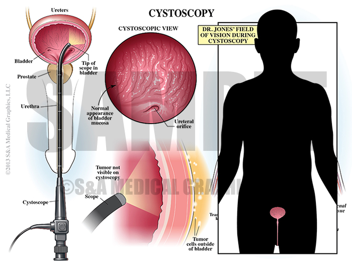 Cystoscopy Procedure Medical Illustration