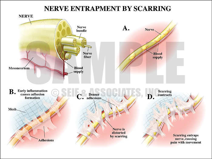 Nerve Entrapment By Scarring Medical Illustration