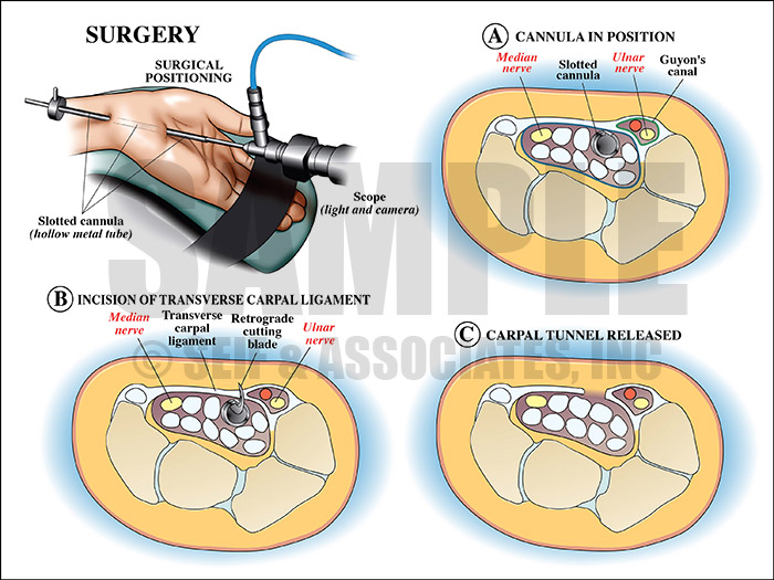 Carpal Tunnel Surgery Medical Illustration