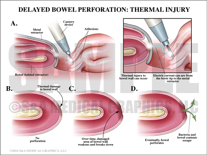 Delayed Bowel Perforation Thermal Injury