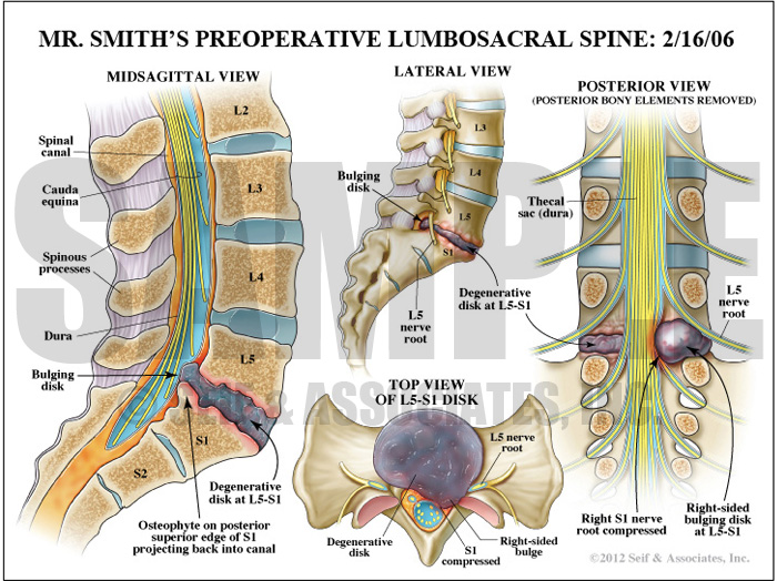 L4 5 Nerve Root Compression