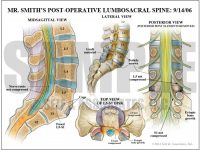 Lumbar Nerve Root Case Study - S&A Medical Graphics
