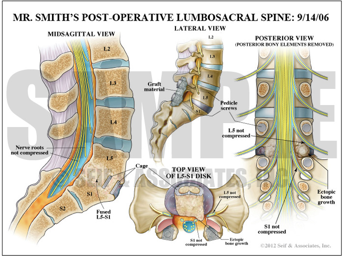 Postoperative Lumbosacral Spine Medical Illustration