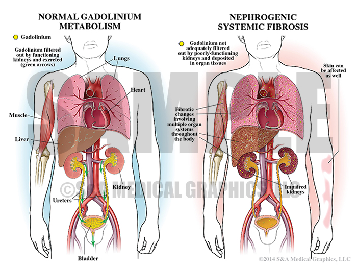 Nephrogenic Systemic Fibrosis Medical Illustration