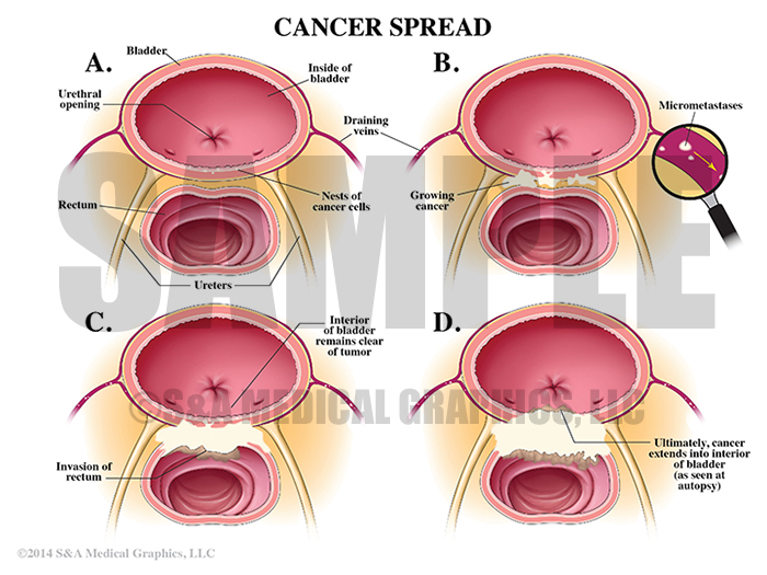 Cancer Spread in Bladder Medical Illustration